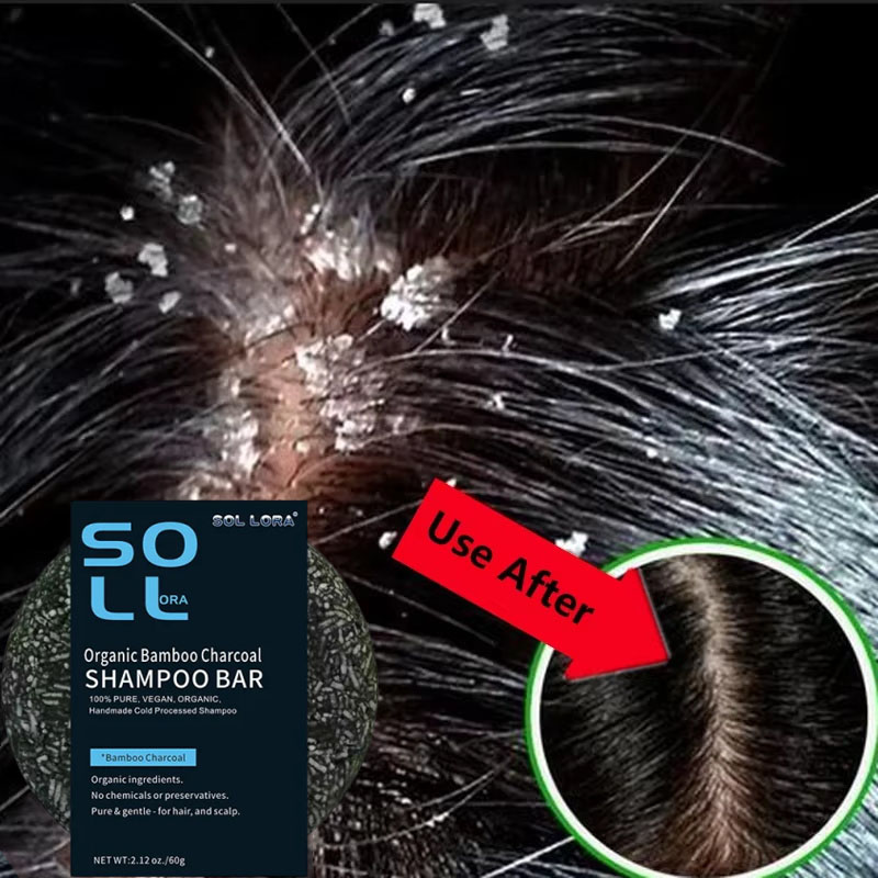 Hair Care Dandruff - Sabonete de tratamento capilar anticaspa rápido,