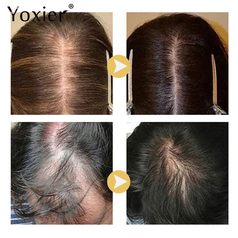 Soro de crescimento intensivo  - Hair Care For Hair Growth avaliação e preço