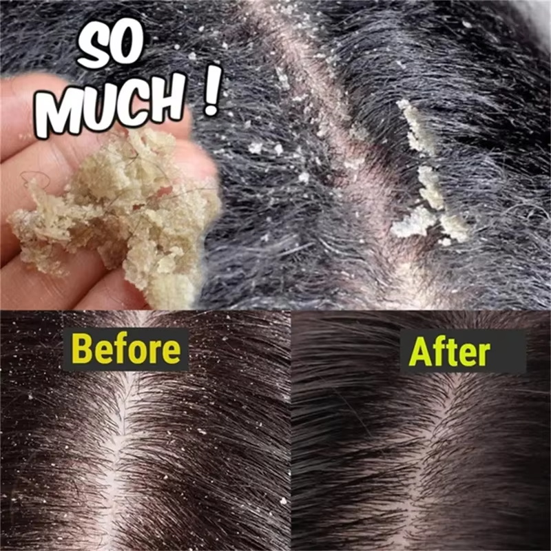 Sabonete de tratamento capilar - Hair Care Dandruff avaliação e preço